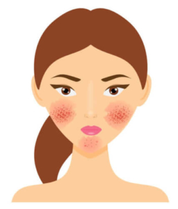 Rosacea und Couperose