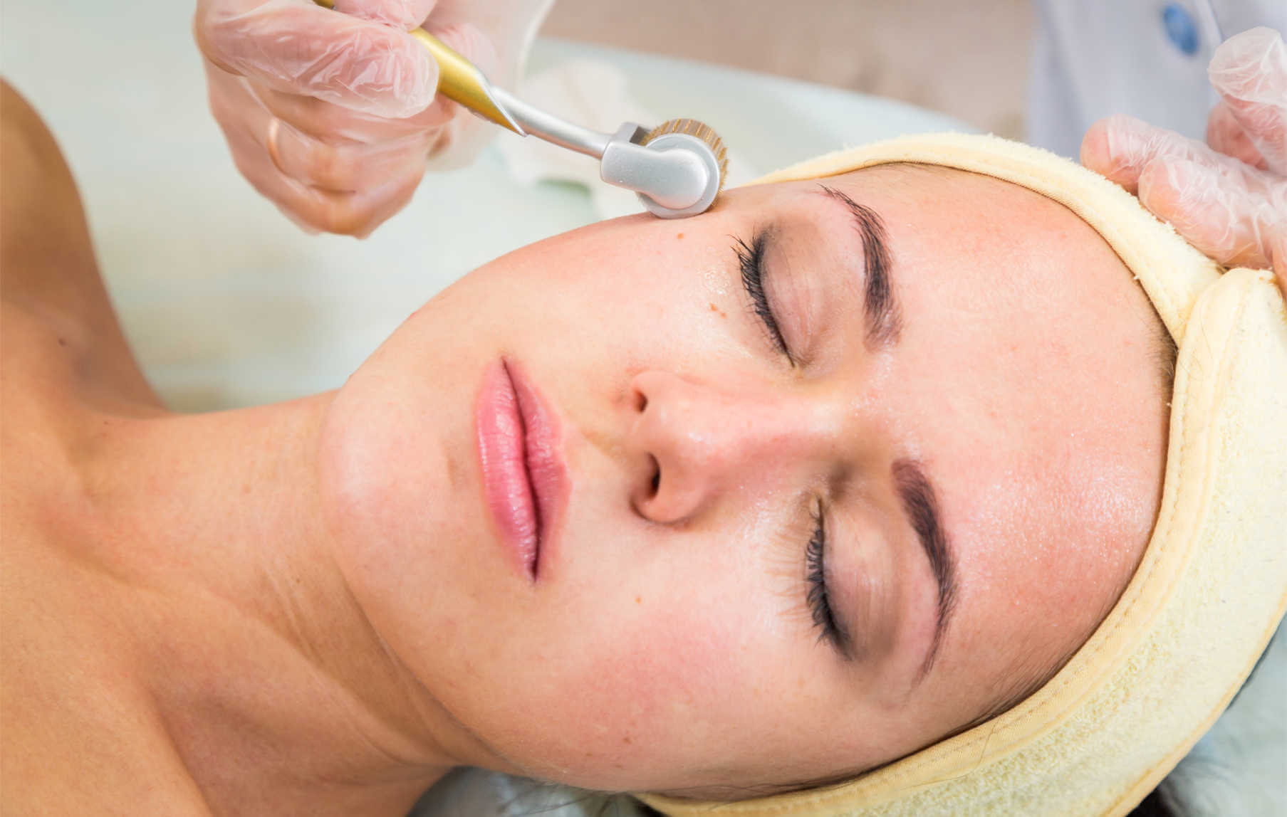 Microneedling