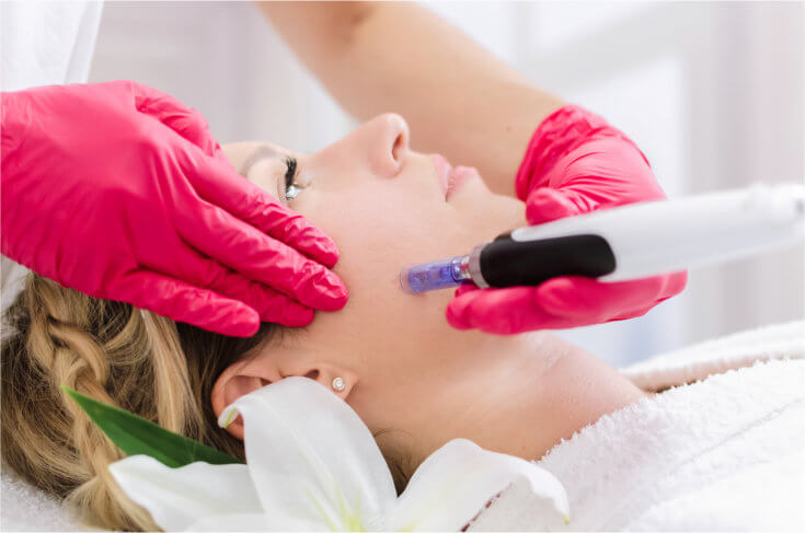 Microneedling Behandlung